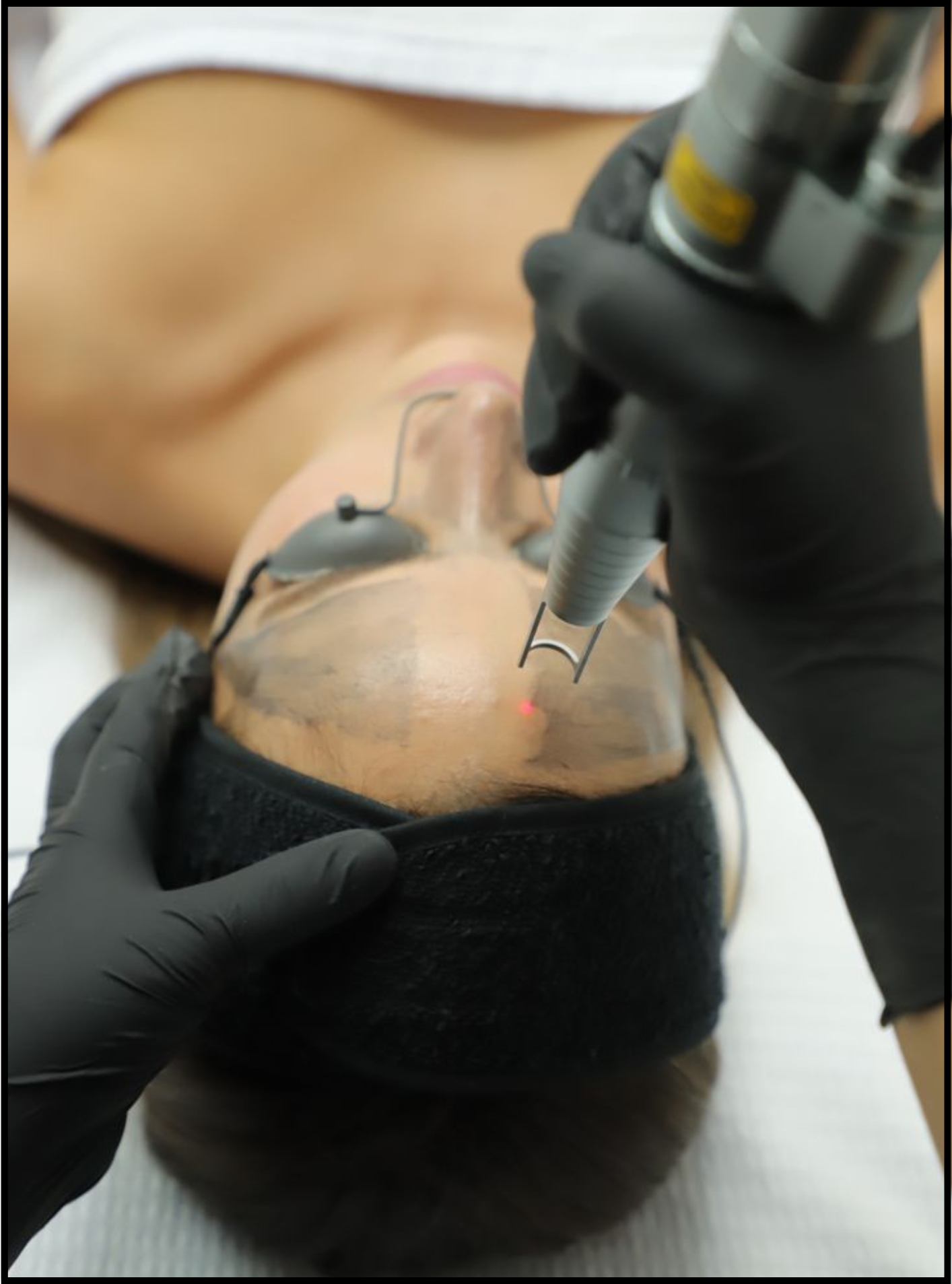 Détatouage & Hollywood Peel