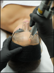 Détatouage & Hollywood Peel