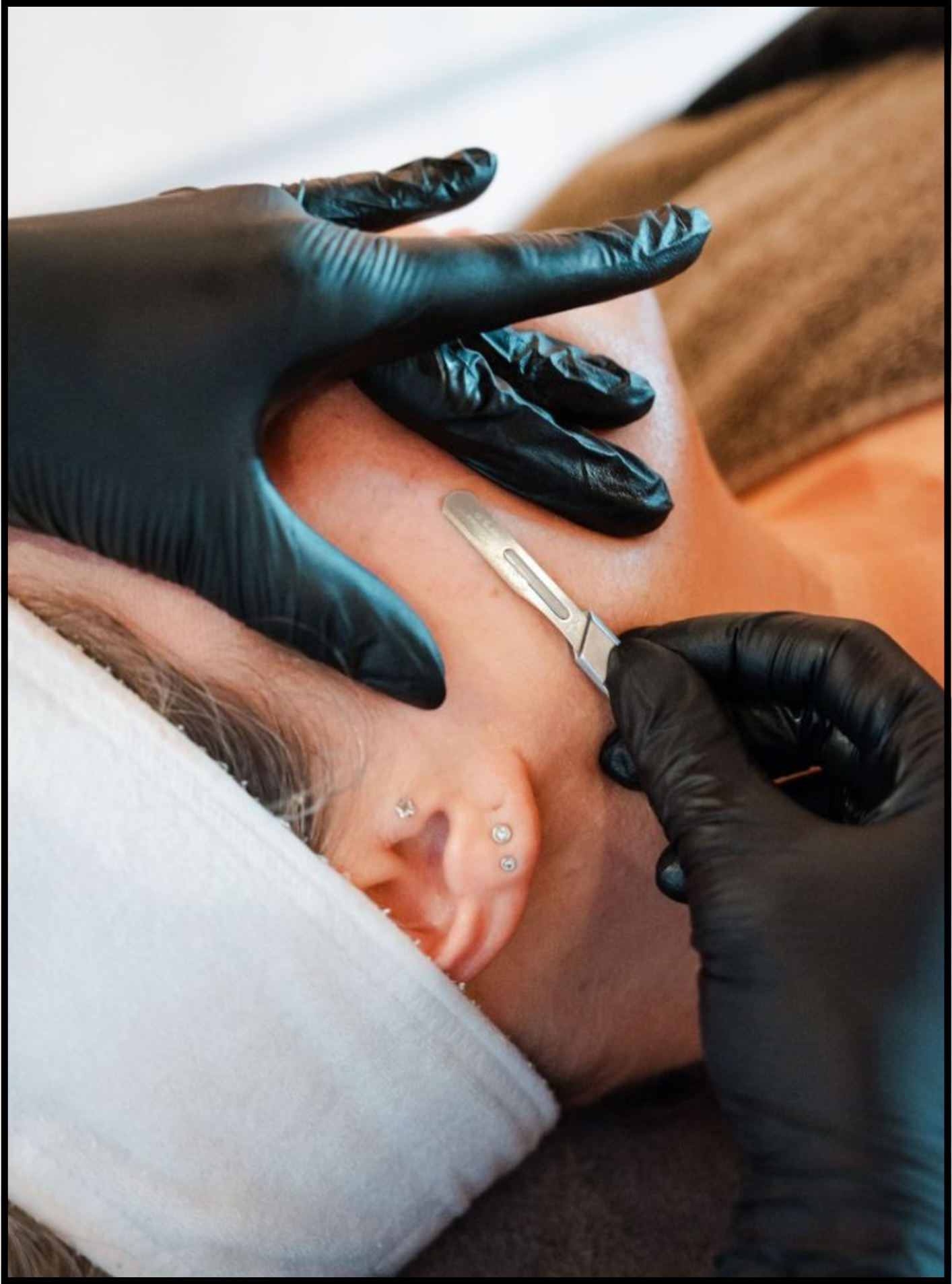 Dermaplaning